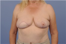 Breast Reconstruction After Photo by Trent Douglas, MD; Greenbrae, CA - Case 31408