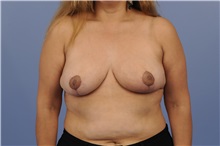 Breast Reduction After Photo by Trent Douglas, MD; Greenbrae, CA - Case 31411