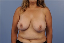 Breast Reduction Before Photo by Trent Douglas, MD; Greenbrae, CA - Case 31411