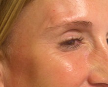 Botulinum Toxin After Photo by Richard Greco, MD; Savannah, GA - Case 31465