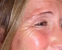 Botulinum Toxin Before Photo by Richard Greco, MD; Savannah, GA - Case 31465