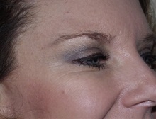 Botulinum Toxin After Photo by Richard Greco, MD; Savannah, GA - Case 31467