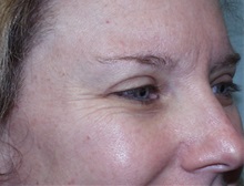 Botulinum Toxin Before Photo by Richard Greco, MD; Savannah, GA - Case 31467