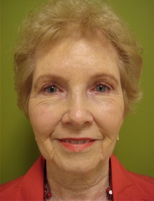 Brow Lift After Photo by Richard Greco, MD; Savannah, GA - Case 31480