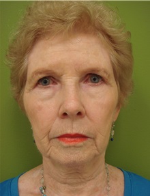 Brow Lift Before Photo by Richard Greco, MD; Savannah, GA - Case 31480