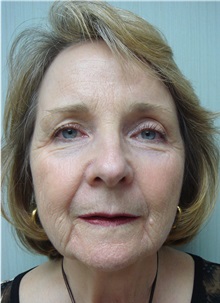 Brow Lift After Photo by Richard Greco, MD; Savannah, GA - Case 31481