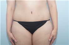 Tummy Tuck After Photo by Keith Neaman, MD; Salem, OR - Case 31631