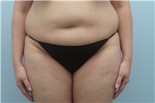 Tummy Tuck Before Photo by Keith Neaman, MD; Salem, OR - Case 31631