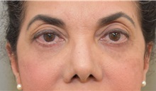 Eyelid Surgery After Photo by Keshav Magge, MD; Bethesda, MD - Case 31651