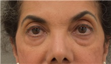 Eyelid Surgery Before Photo by Keshav Magge, MD; Bethesda, MD - Case 31651