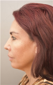 Facelift Before Photo by Keshav Magge, MD; Bethesda, MD - Case 31664