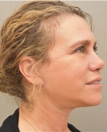 Facelift After Photo by Keshav Magge, MD; Bethesda, MD - Case 31665