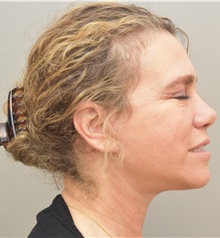 Facelift After Photo by Keshav Magge, MD; Bethesda, MD - Case 31665