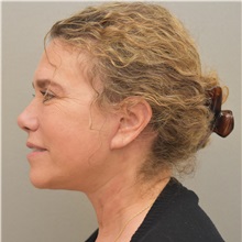 Facelift After Photo by Keshav Magge, MD; Bethesda, MD - Case 31665