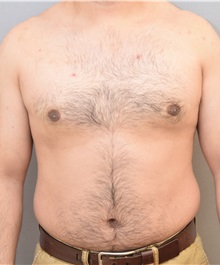 Male Breast Reduction After Photo by Keshav Magge, MD; Bethesda, MD - Case 31814