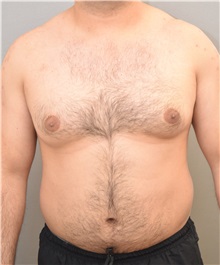 Male Breast Reduction Before Photo by Keshav Magge, MD; Bethesda, MD - Case 31814