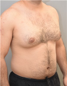 Male Breast Reduction Before Photo by Keshav Magge, MD; Bethesda, MD - Case 31814