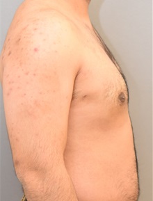 Male Breast Reduction After Photo by Keshav Magge, MD; Bethesda, MD - Case 31814