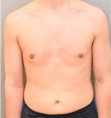 Male Breast Reduction After Photo by Keshav Magge, MD; Bethesda, MD - Case 31815