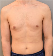 Male Breast Reduction Before Photo by Keshav Magge, MD; Bethesda, MD - Case 31815