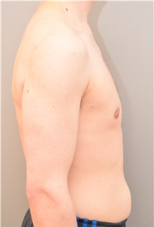 Male Breast Reduction After Photo by Keshav Magge, MD; Bethesda, MD - Case 31815