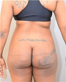 Buttock Lift with Augmentation Before Photo by Keshav Magge, MD; Bethesda, MD - Case 31819