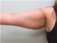 Liposuction Before Photo by Richard Greco, MD; Savannah, GA - Case 31906