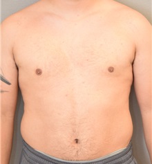 Male Breast Reduction After Photo by Keshav Magge, MD; Bethesda, MD - Case 31919