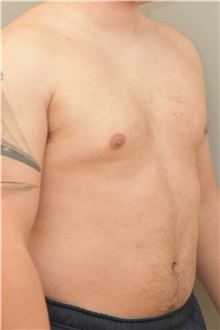 Male Breast Reduction Before Photo by Keshav Magge, MD; Bethesda, MD - Case 31919