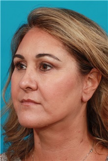 Facelift After Photo by Michael Bogdan, MD, MBA, FACS; Grapevine, TX - Case 31992