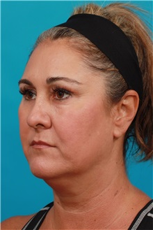 Facelift Before Photo by Michael Bogdan, MD, MBA, FACS; Grapevine, TX - Case 31992