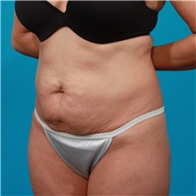 Tummy Tuck Before Photo by Michael Bogdan, MD, MBA, FACS; Grapevine, TX - Case 32041