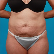 Tummy Tuck Before Photo by Michael Bogdan, MD, MBA, FACS; Grapevine, TX - Case 32041