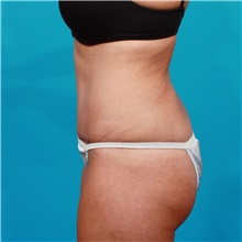 Tummy Tuck After Photo by Michael Bogdan, MD, MBA, FACS; Grapevine, TX - Case 32041