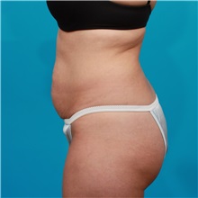 Tummy Tuck Before Photo by Michael Bogdan, MD, MBA, FACS; Grapevine, TX - Case 32041