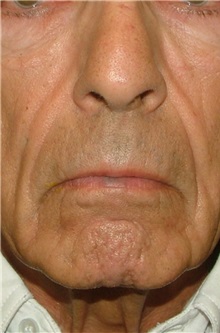 Dermal Fillers Before Photo by Arturo Guiloff, MD; Palm Beach Gardens, FL - Case 32095