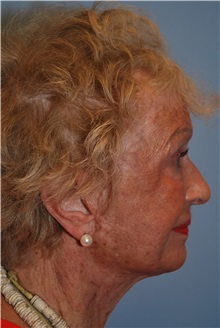 Facelift After Photo by Kristoffer Ning Chang, MD; San Francisco, CA - Case 32602