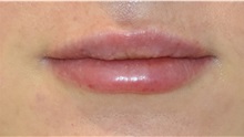 Lip Augmentation/Enhancement After Photo by Richard Reish, MD, FACS; New York, NY - Case 32882