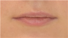 Lip Augmentation/Enhancement Before Photo by Richard Reish, MD, FACS; New York, NY - Case 32882