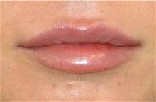 Lip Augmentation/Enhancement After Photo by Richard Reish, MD, FACS; New York, NY - Case 32883