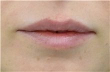 Lip Augmentation/Enhancement Before Photo by Richard Reish, MD, FACS; New York, NY - Case 32883