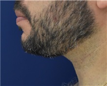 Chin Augmentation After Photo by Richard Reish, MD, FACS; New York, NY - Case 32893