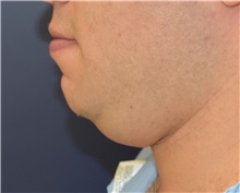 Chin Augmentation Before Photo by Richard Reish, MD, FACS; New York, NY - Case 32893