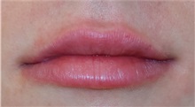 Lip Augmentation/Enhancement After Photo by Richard Reish, MD, FACS; New York, NY - Case 32898