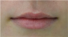 Lip Augmentation/Enhancement Before Photo by Richard Reish, MD, FACS; New York, NY - Case 32898