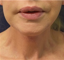 Facelift After Photo by Richard Reish, MD, FACS; New York, NY - Case 32927