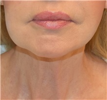 Facelift Before Photo by Richard Reish, MD, FACS; New York, NY - Case 32927