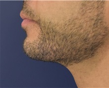 Chin Augmentation After Photo by Richard Reish, MD, FACS; New York, NY - Case 32930