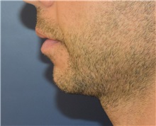 Chin Augmentation Before Photo by Richard Reish, MD, FACS; New York, NY - Case 32930