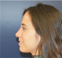 Rhinoplasty After Photo by Richard Reish, MD, FACS; New York, NY - Case 33193